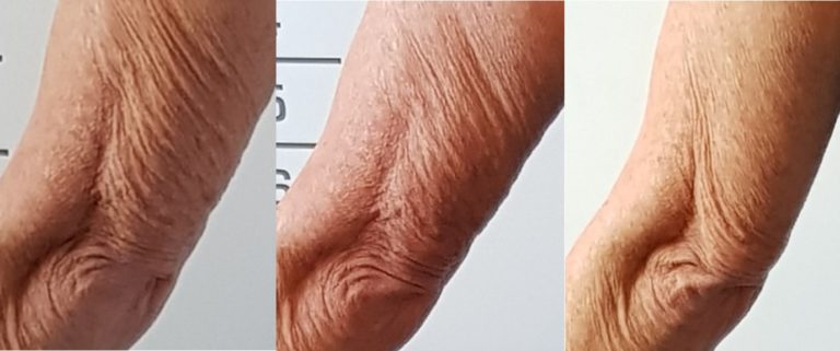 Loose Skin On Rear Of Arms Reconstruct EndermoTherapy Movement Coaching loose-skin-on-rear-of-arms-reconstruct-endermotherapy-movement-coaching